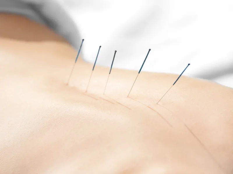 Acupuncture at Carlisle Spine And Wellness in Carl Isle