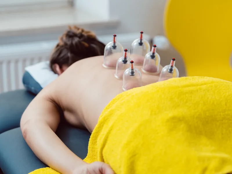 Cupping Therapy at Carlisle Spine And Wellness in Carl Isle