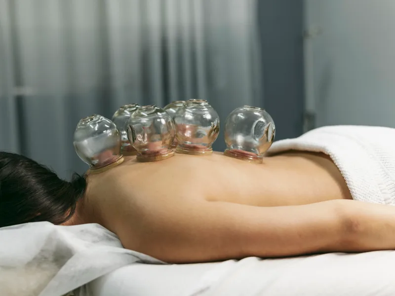 Cupping Therapy at Carlisle Spine And Wellness in Carl Isle
