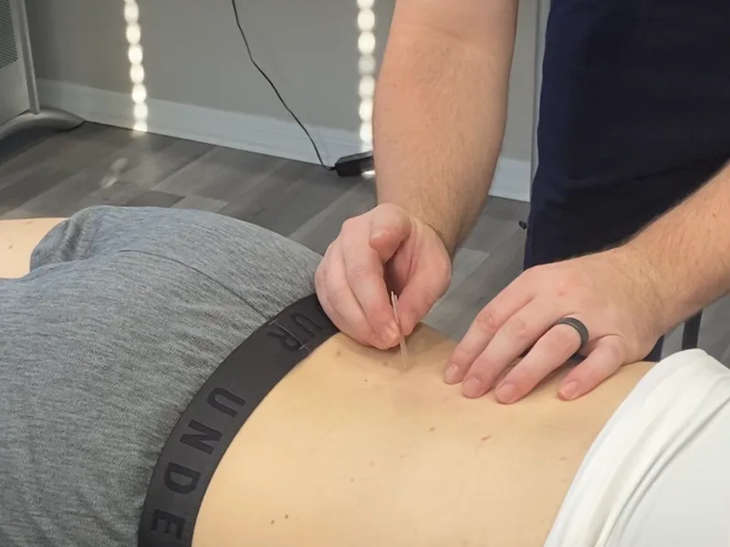How Dry Needling works at Carlisle Spine And Wellness