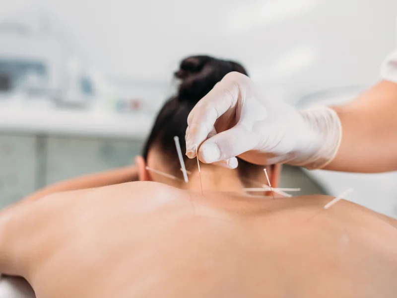 Dry Needling at Carlisle Spine And Wellness in Carl Isle